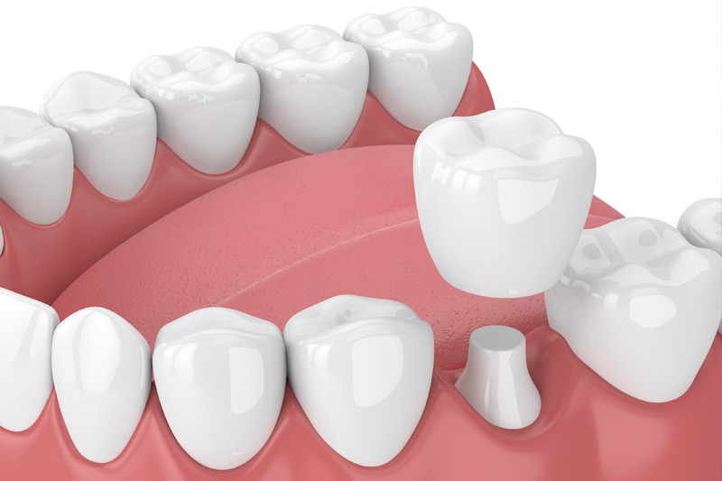 Dental Crowns in New Canaan