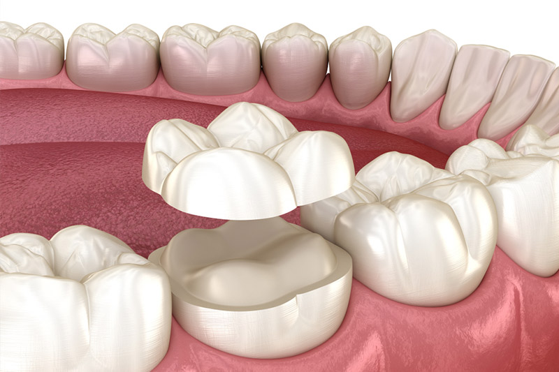Dental Crowns in New Canaan