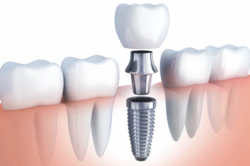 Implants Dentist in New Canaan