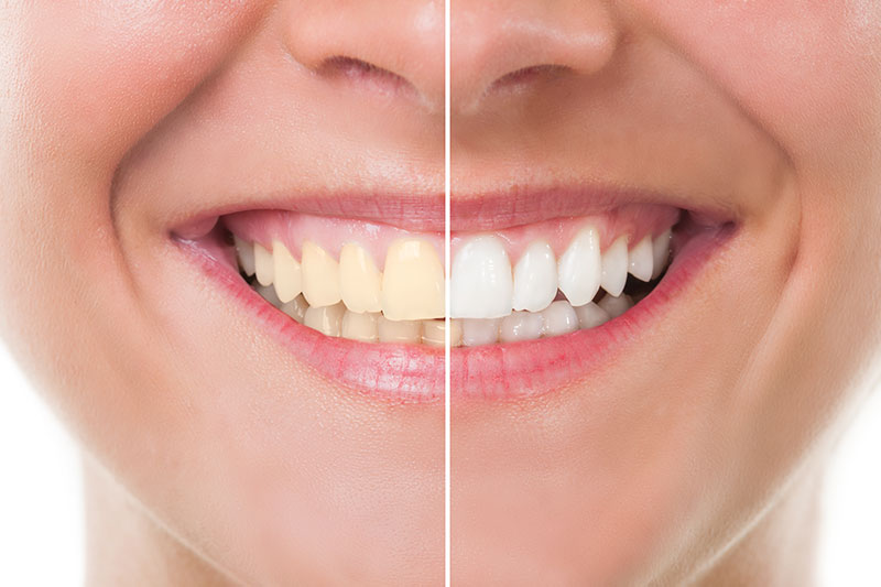 Teeth Whitening in New Canaan